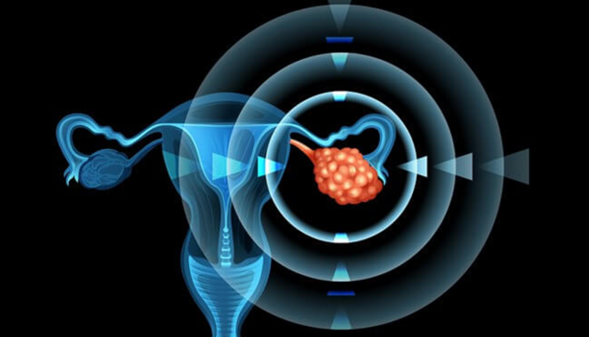 Ovarian Cancer Treatment in Hyderabad