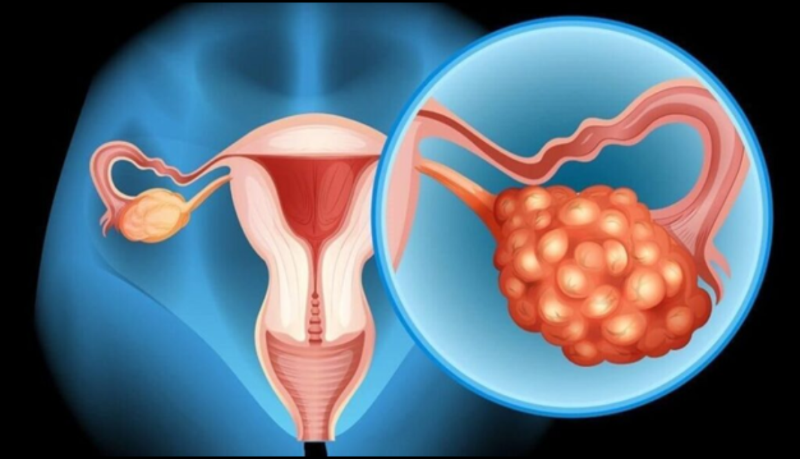 Difficulties in Diagnosing Ovarian Cancer