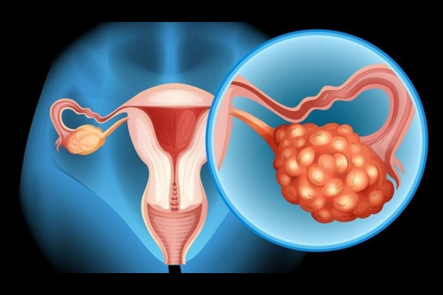 Difficulties in Diagnosing Ovarian Cancer