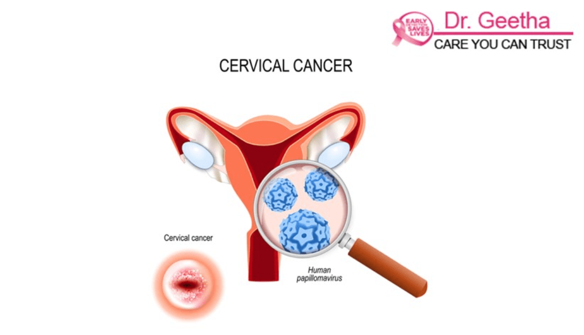 Cervical Cancer Causes Risk Factors Symptoms and Treatments