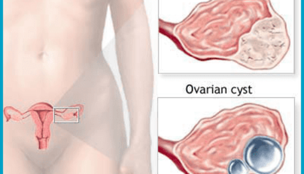 cyst removal surgery in Hyderabad