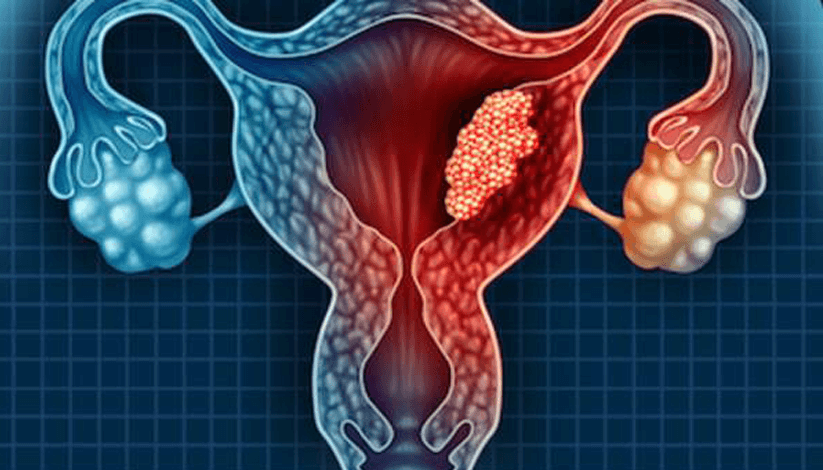 Endometrial (Uterine) Cancer – Causes, Risk Factors & Symptoms