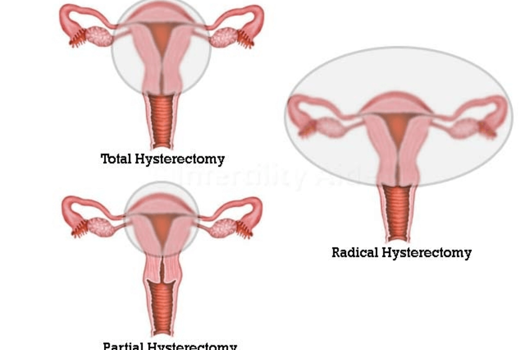 Laparoscopic Hysterectomy (Hysterectomy Types)