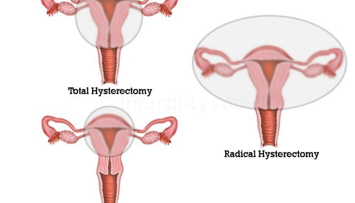 Hysterectomy in Hyderabad