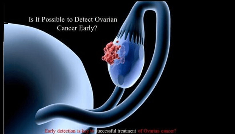 How to Detect Ovarian Cancer Early