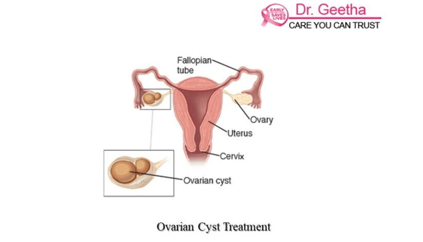 The Best Ovarian Cyst Treatment in Hyderabad | Dr Geetha Nagasree