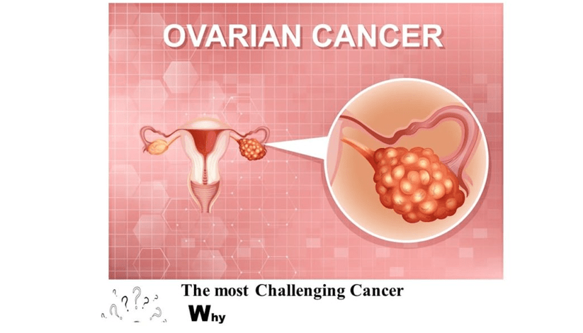 Ovarian cancer Hyderabad