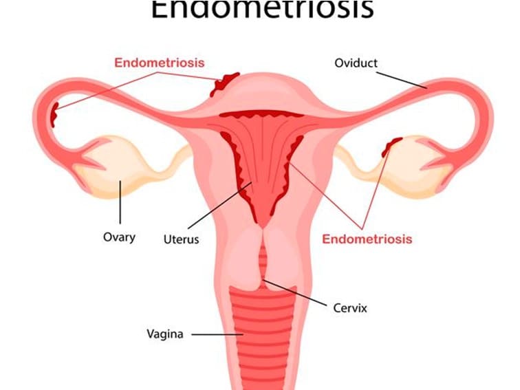 Endometriosis Treatment in Hyderabad