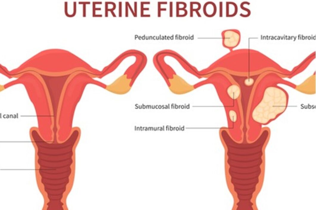 Laparoscopic Surgery for Uterine Fibroids