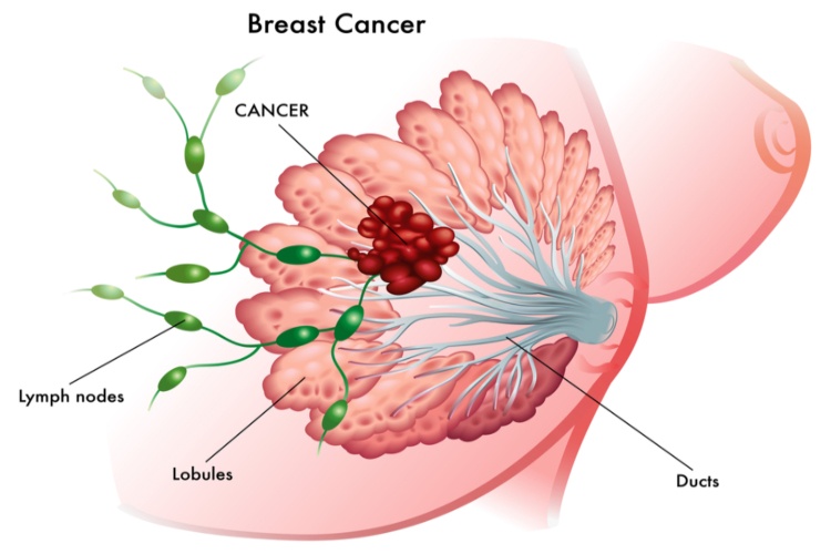 Rare types of breast cancer