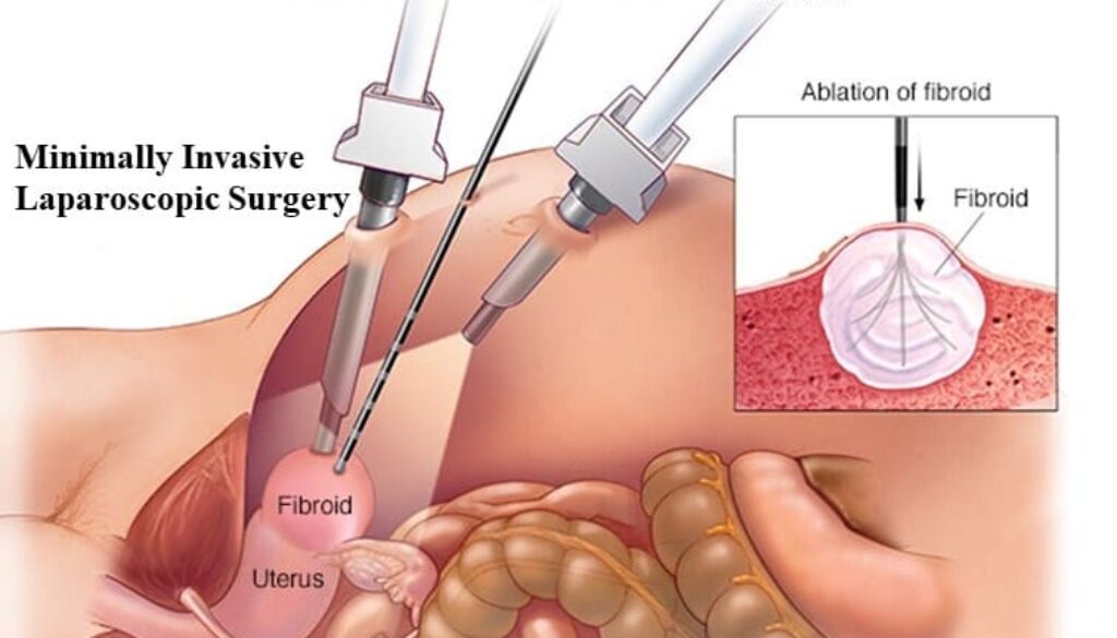 Laparoscopic surgery for endometriosis