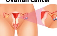 frequently asked questions about ovarian cancer