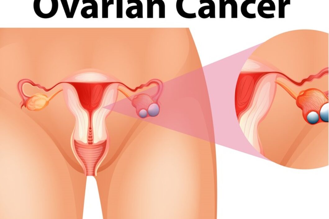 Surgeries for advanced and recurrent ovarian cancers