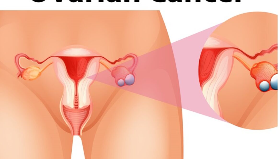 Surgeries for Advanced and Recurrent Ovarian Cancers