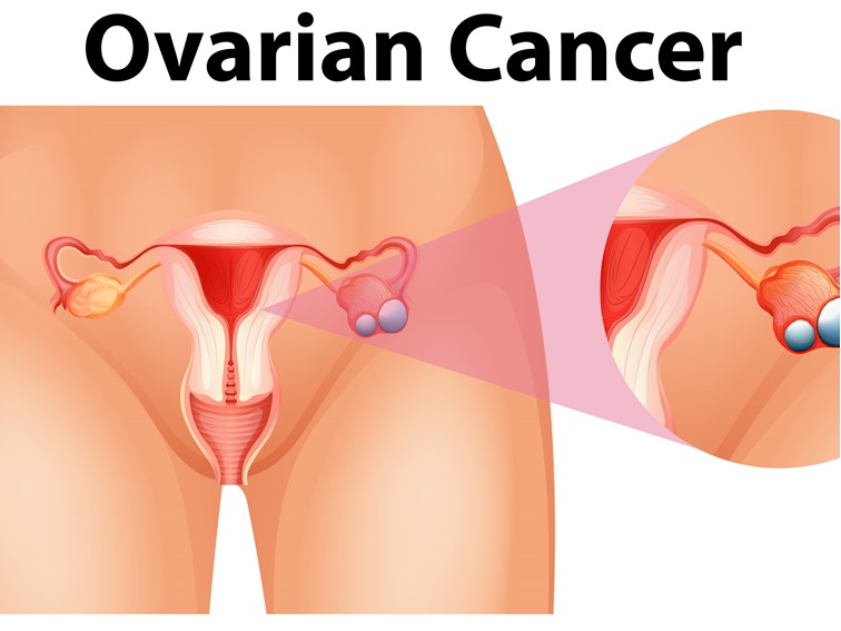 Surgeries for Advanced and Recurrent Ovarian Cancers