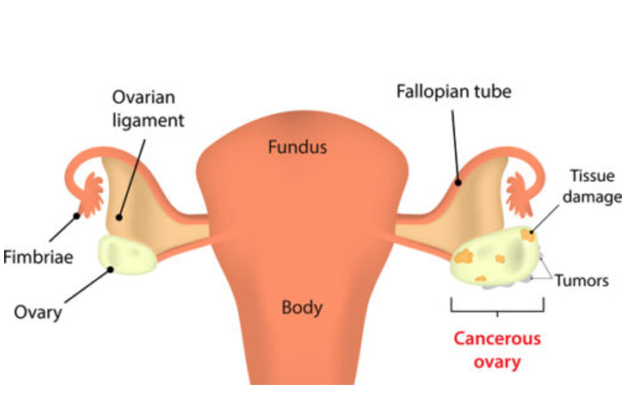 Beware! Ovarian Cancer is on the Rise in Women HYDERABAD TREATMENT