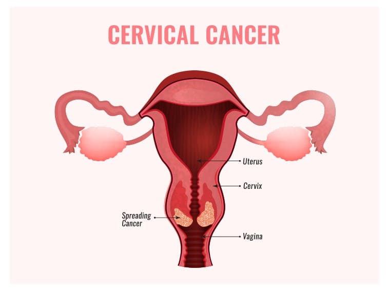 cervical cancer cases in India