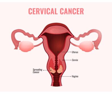 stage IV cervical cancer treatment
