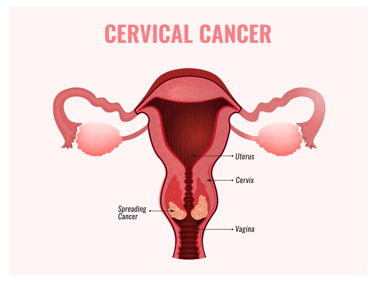 stage IV cervical cancer treatment