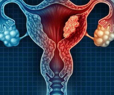 endometrial cancer treatment