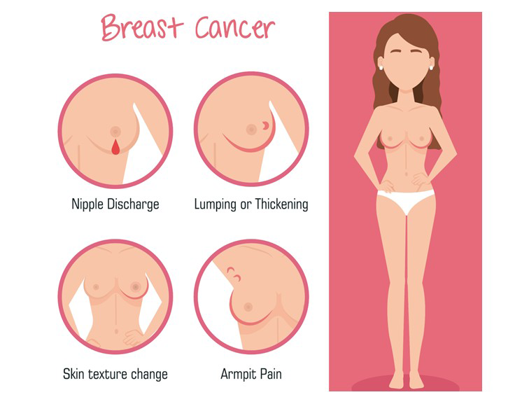 Early Warning Signs of Breast Cancer Women Often Overlook