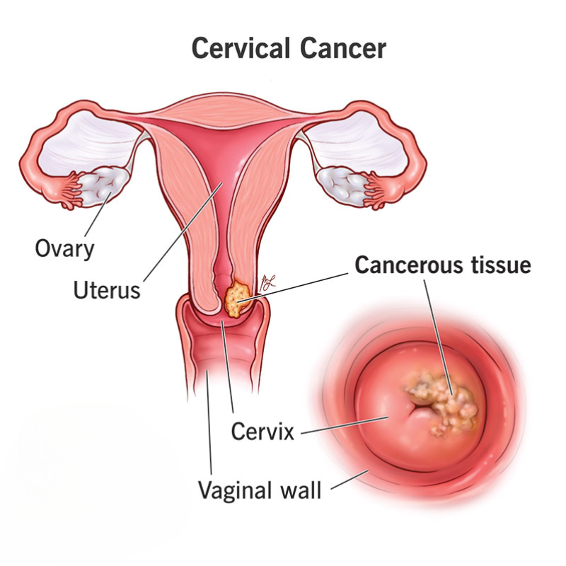 Cervical Cancer Treatment