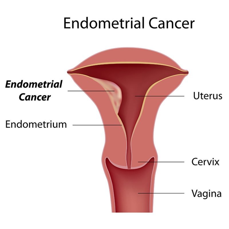 Endometrial (Uterine) Cancer Treatment