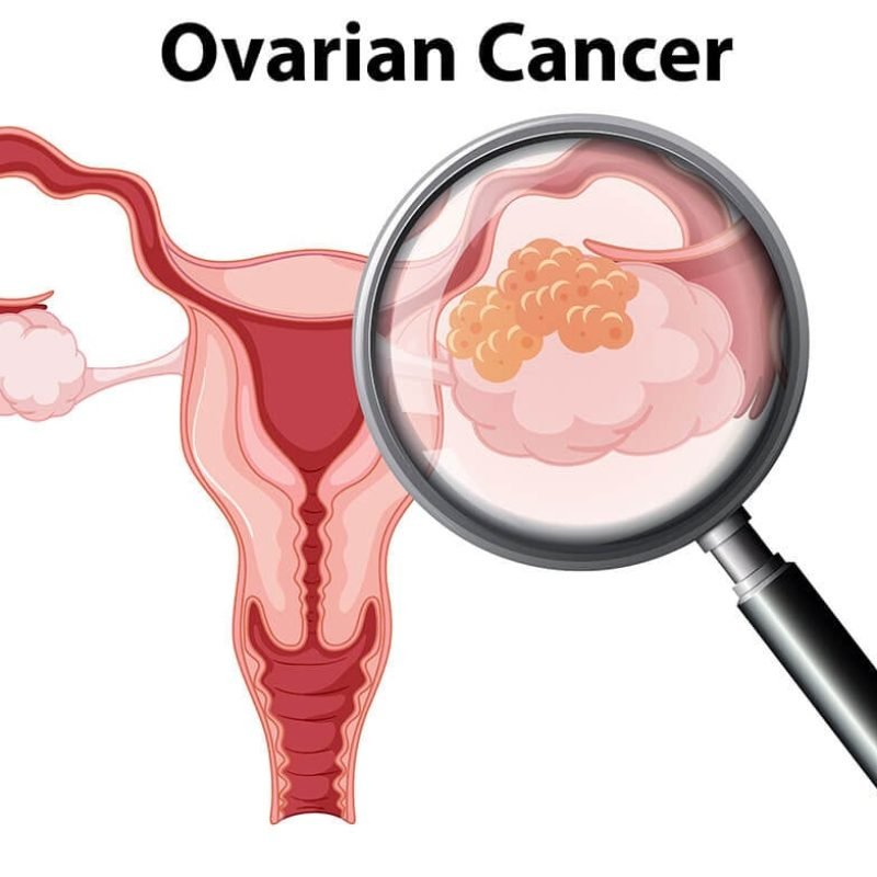Ovarian cancer Treatment