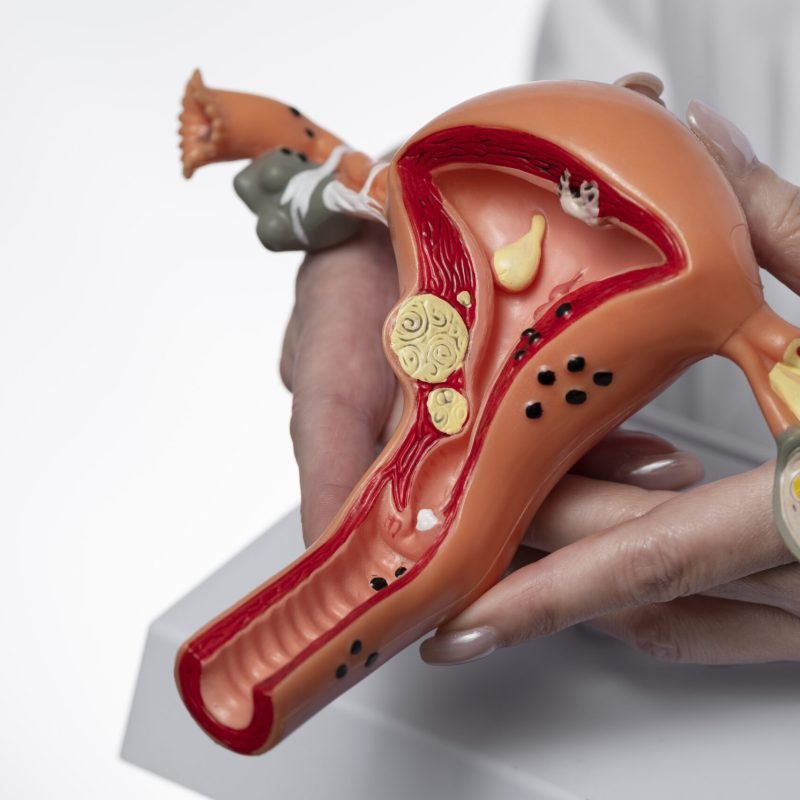 Uterus Removal Surgery